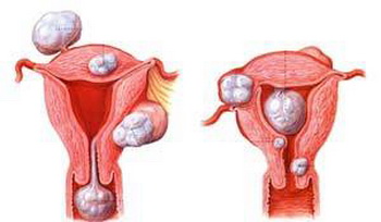 子宫肌瘤为什么会导致不孕?