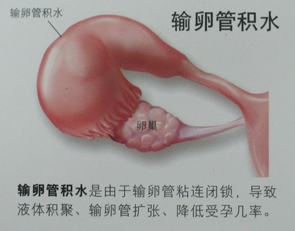 输卵管积水，做试管婴儿前一定要治疗吗？