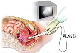 卵巢储备功能检测之窦卵泡计数（AFC）