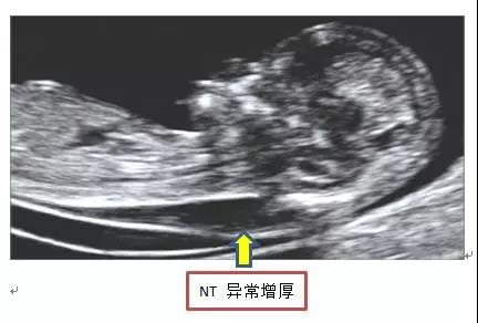 早孕期为什么要做NT筛查？