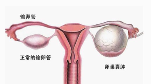 哪些卵巢性疾病会导致女性不孕症的发生呢？