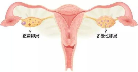哪些卵巢性疾病会导致女性不孕症的发生呢？