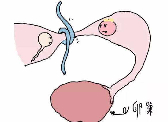 女性做了输卵管结扎后，怎么生二胎啊？