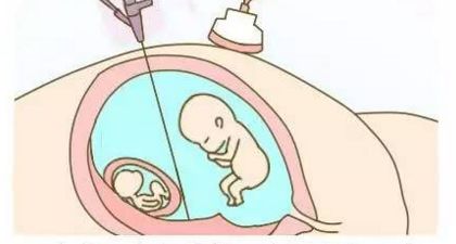 双胎不一定是上天的小天使，而是试管婴儿治疗的并发症