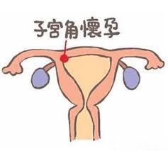 宫内外复合妊娠的“生殖”处理方式
