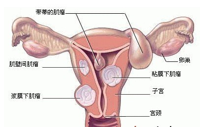 子宫肌瘤是什么？会影响生育吗？