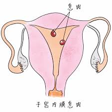 个影响胚胎着床率的宫腔病变"