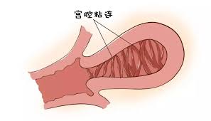 个影响胚胎着床率的宫腔病变"