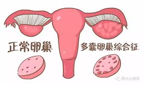 导致多囊卵巢综合征的病因有哪些?