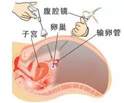 输卵管常用的检查方法有哪些？