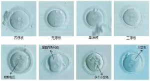 第三代试管婴儿中原核期胚胎评估的意义